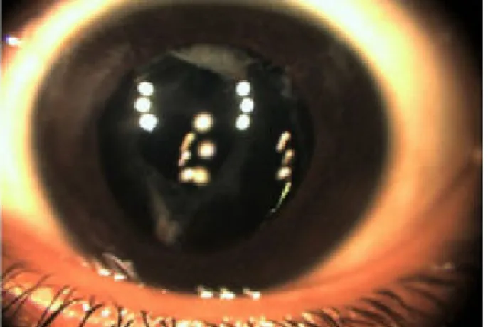 Figure 3: Post operative anterior segment photo of the left eye