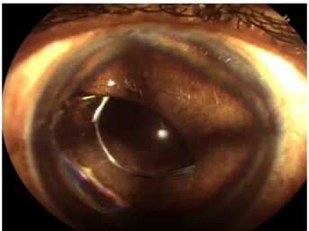 Figure 1: Clinical photograph. Status post mydriasis: anterior dislocation of intraocular lens