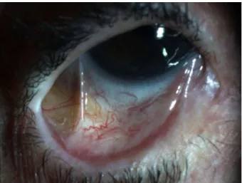 Figure 2: Foreshortening and symblepharon of the right lower palpebral conjunctiva