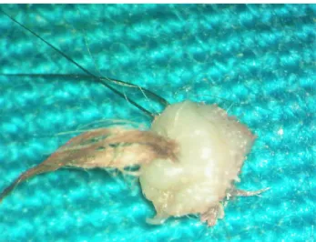 Figure 2: Clinical photograph of the specimen after surgical excision