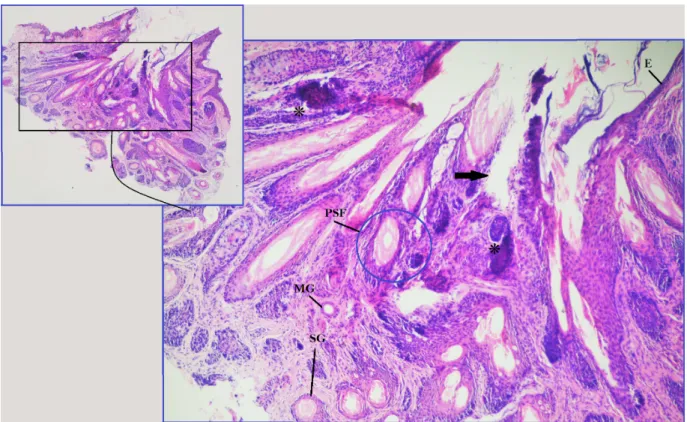 Figure 3: Photomicrograph shows lash follicle (*), its fibrous tract (arrow), epidermis (E), Molls gland (MG), sebaceous gland (SG) and pilosebaceous follicle (PSF).