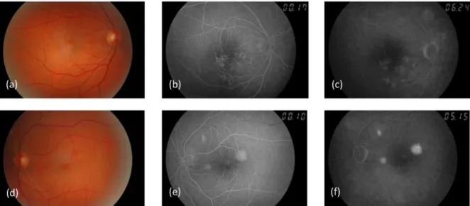 Figure 1: Right (a–c) and left (d–f) eye. Color photographs of the fundus (a, d) , early- (b, e) and late-phase (c, f) fluorescein angiograms