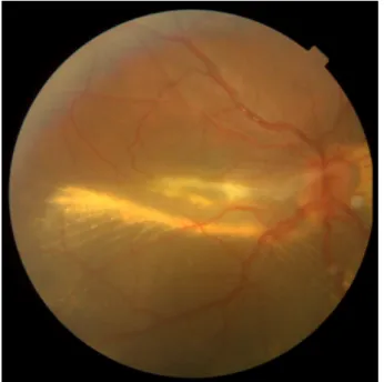 Figure 2: Fluorescein angiogram of the right eye showed diffuse hyper fluorescence which corresponded to telangectatic vessels