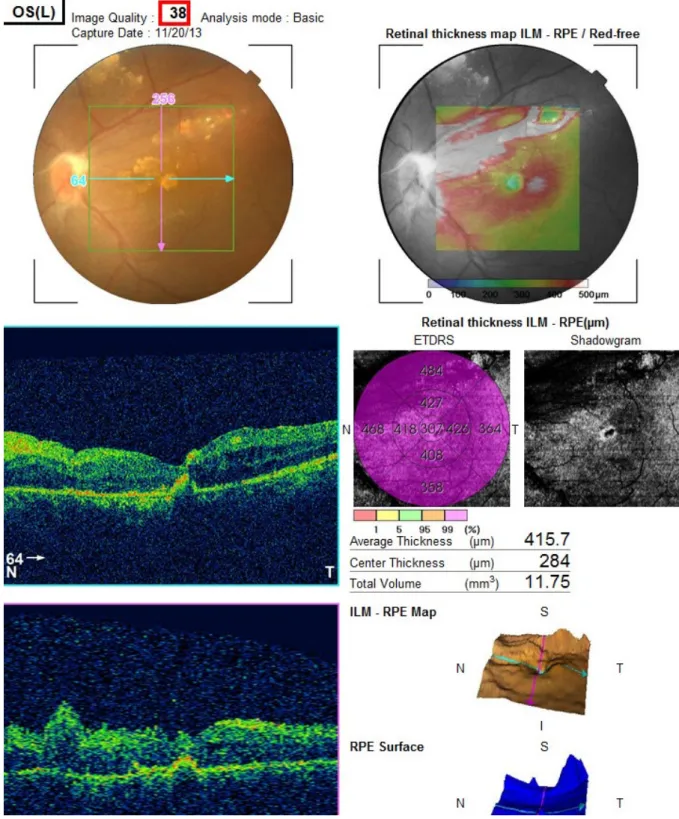 Figure 6: Left eye OCT with macular atrophy and intra and sub retinal hyper-reflective materialNourinia et al.: Intravitreal bevacizumab role in the treatment of ...