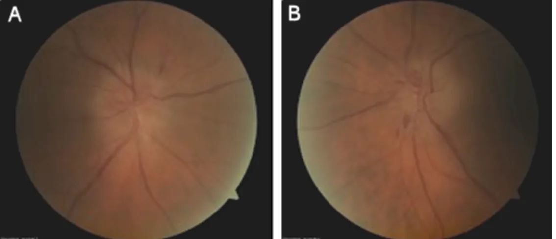 Figure 1: Papillary oedema at the begining in A) the right eye and B) the left eye