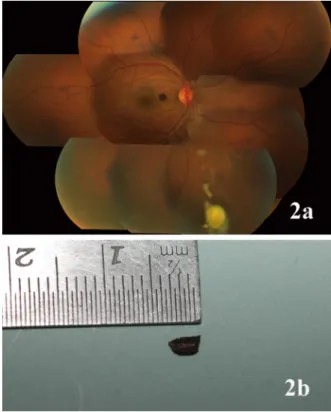 Figure 2: (a) Fundus montage of case 1 showing the IOFB obscured by surrounding exudates in the inferior periphery.