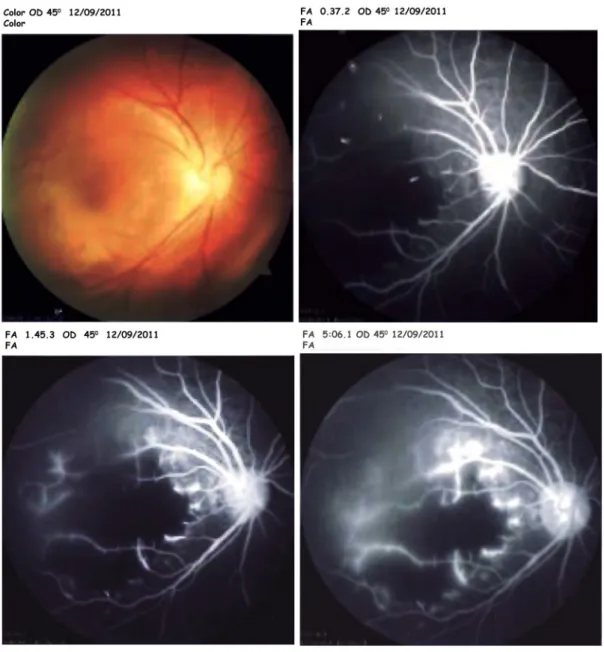 Figure 4: Angiography of the right eye showed macular ischemia
