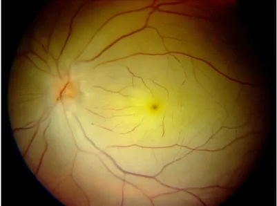 Figure 2: Color photography shows a pale retina with pronounced disturbance of the retinal circulation in the posterior pole.