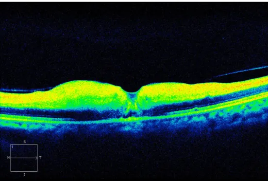 Figure 6: Macular OCT shows thickening of the internal retinal layers due to edema and ischemia