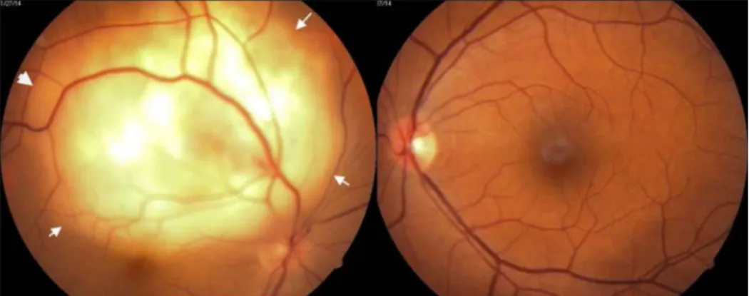 Figure 1: RE showing subretinal mass lesion. White arrows demarcating the outline of retinal detachment.