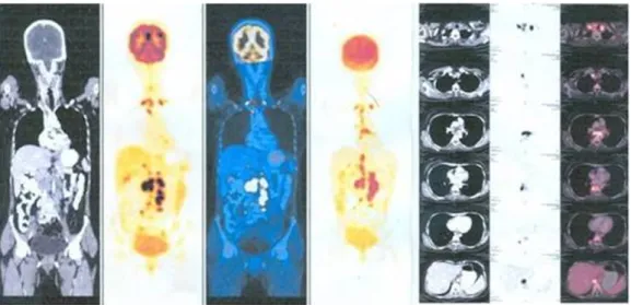 Figure 4: PET scan shows enlarged lymph nodes in cervical, mediastinal, and retroperitoneal regions.