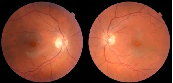 Figure 1: Color fundus image of both eyes that show white discolorations in the fovea