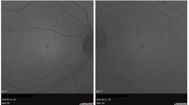 Figure 4: Near-infrared fundus autofluorescence images (NIA) of both eyes: clearly visible hypoautofluorescent spots in the fovea