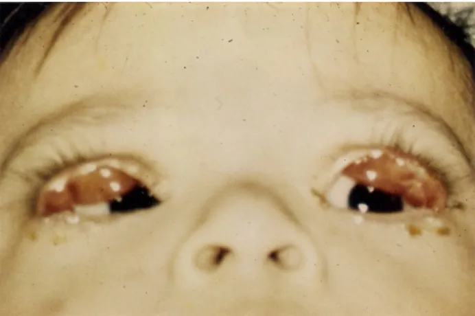 Figure 1: Age: 8 months. Preoperative picture showing marked bilateral, congenital ectropion of the upper eyelids