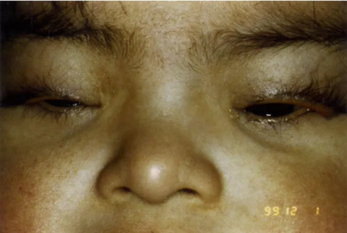 Figure 2: Intraoperative picture showed full-thickness skin graft upper eyelids.