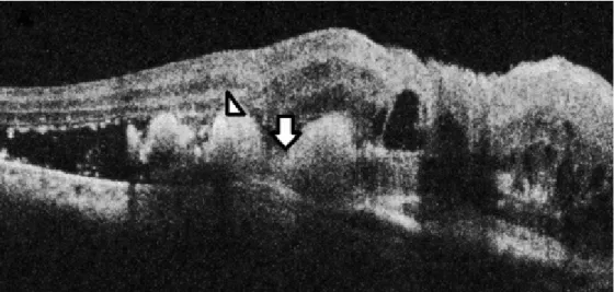 Figure 1: OCT of the right eye showing multiple hemorrhagic PEDs with notch (arrow) and underlying polyps (arrow head) surrounded by SRF