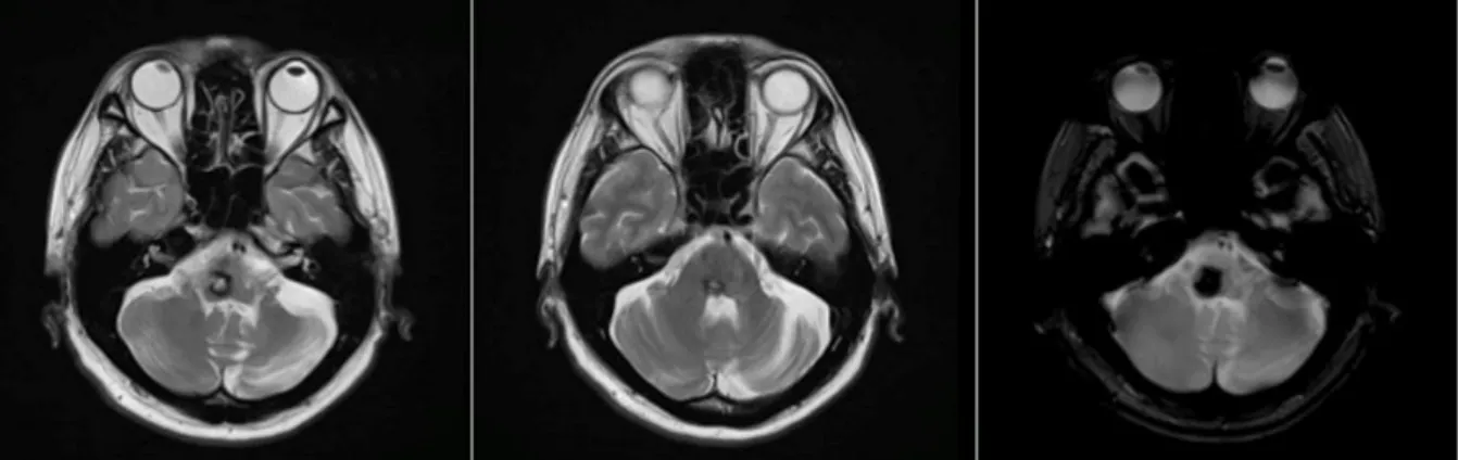 Figure 3: T2-weighted images from the patient’s cranial magnetic resonance imaging