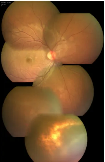 Figure 3: Three weeks after presentation. Color fundus montage of the right eye reveals minimal media haze overlying the affected quadrant with an area of chorioretinal pigmentation.