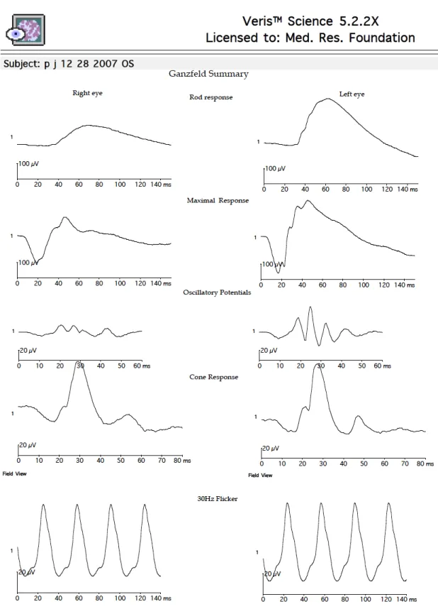 Figure 4: Global ERG reveals reduced scotopic responses and depressed oscillatory potential in the right eye
