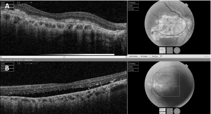 Figure 1: A) Right eye showing disciform scar at initial presentation. B) Left eye showing neurosensory elevation at initial presentation.