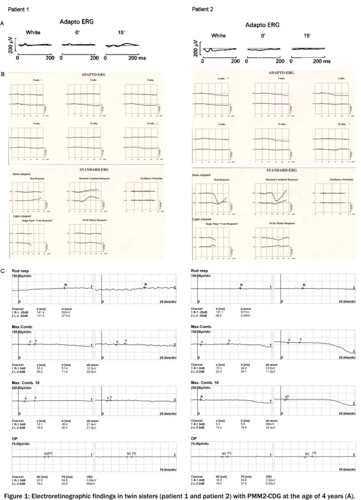 Figure 1: Electroretinographic findings in twin sisters (patient 1 and patient 2) with PMM2-CDG at the age of 4 years (A), 18 years (B) and 41 years (C).