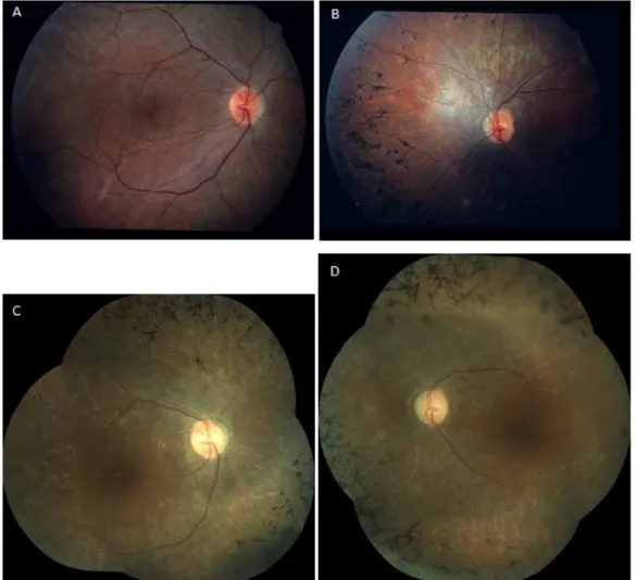 Figure 2: Fundus appearance in twin sisters with PMM2-CDG at the age of 18 and 41 years.