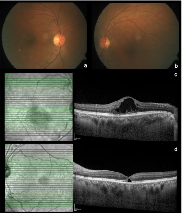 Figure 1: Color fundus photo and spectral domain optical coherence tomography of the right and the left eye.