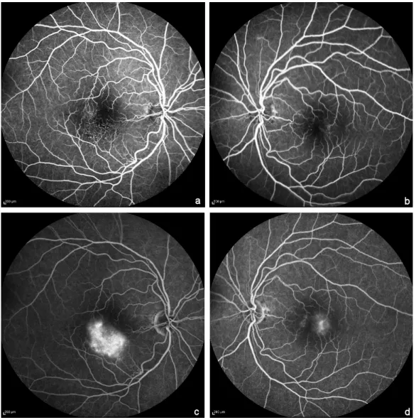 Figure 3: Fundus Fluorescein angiography early (a,b) and late phase (c,d).