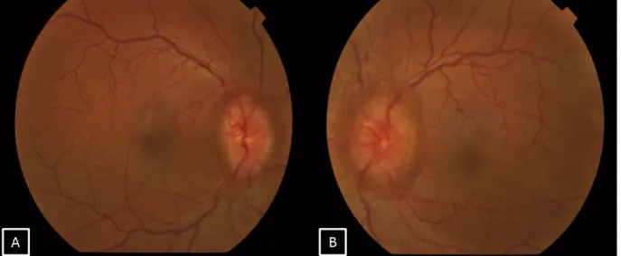 Figure 1: Fundus pictures of the right (A) and left eye (B) showing bilateral optic disc edema suggestive of papilledema
