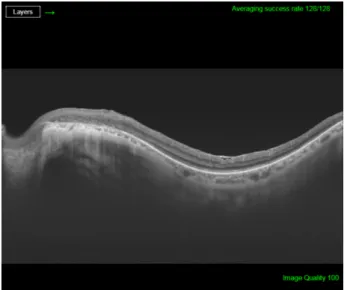 Figure 1: Autofluorescence image of the right eye showing hypoautofluorescence at the paravenous zone