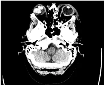 Figure 1: Computerised tomography of the head without contrast revealing a right hyperdense orbital mass, fracture of