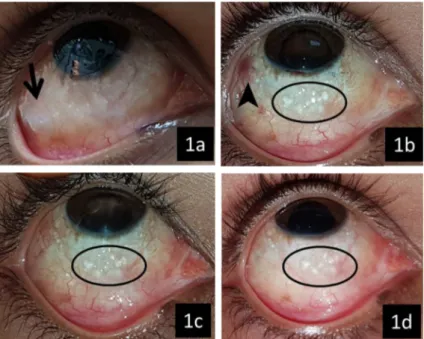 Figure 1: Pre- and postoperative clinical photographs of the conjunctiva of the right eye.