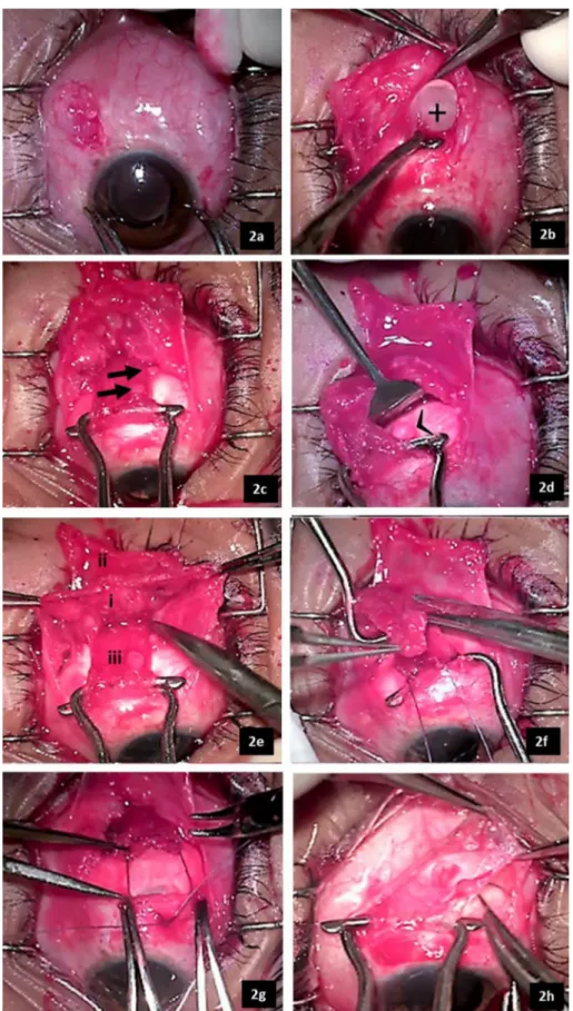 Figure 2: Intraoperative photographs showing the various steps of the strabismus surgery.
