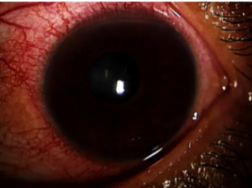 Figure 1: The chemosis with serous discharge