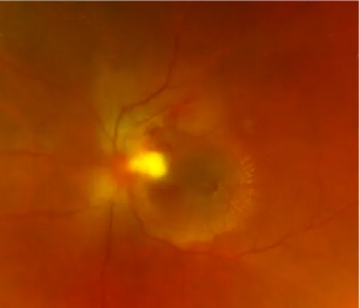 Figure 3: Optic disc swelling, a focal retinitis lesion at the temporal margin of the optic disc, macular exudates in a star