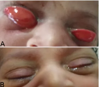 Figure 1: A) One-day-old neonate at presentation with bilateral ectropion, with the right eye showing a more severe chemosis