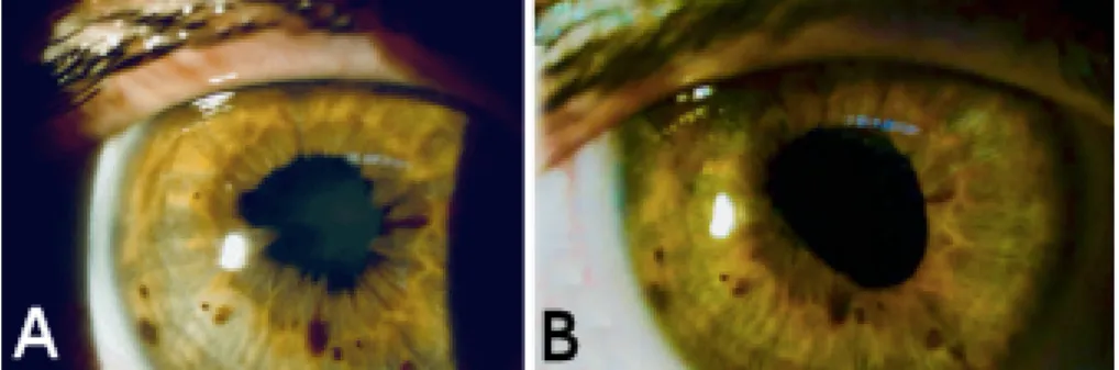 Figure 1: Exploration of the anterior segment (A) before and (B) after cataract and synechiotomy surgery