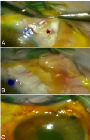 Figure 3: (A, B) Release of fibrous adhesions at the distal end of the XEN ® stent and placement of Ologen ® collagen matrix