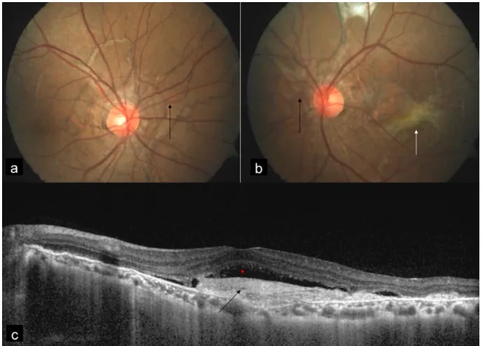 Figure 1: Color fundus photograph (CFP) showed angioid streaks (AS) in the right eye (a) and the left eye (b) (black arrows), and choroidal neovascular membrane (CNV) (white arrow) in the left eye (b)