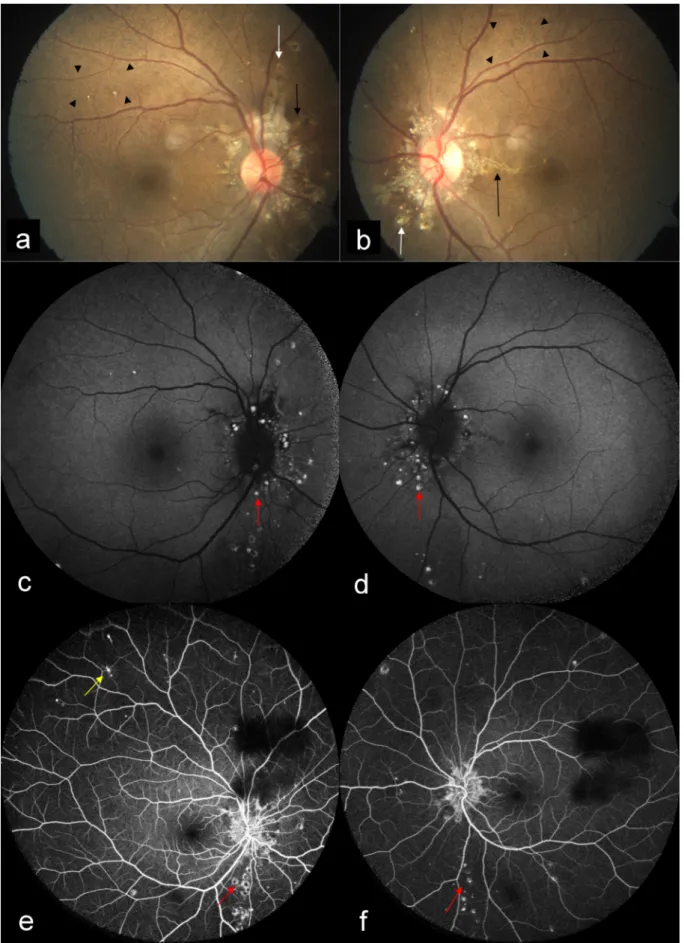 Figure 3: CFP (a, b) showed bilateral AS (black arrows) with peau d’orange as alternating dark and bright patches (arrow heads).