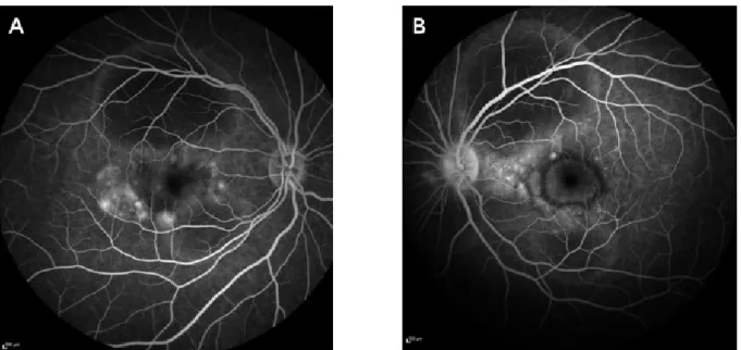 Figure 2: Late-phase fluorescein angiography shows tiny leakage points with limited leakage in the subretinal space (A, B) and discrete staining of the left optic disc (B).