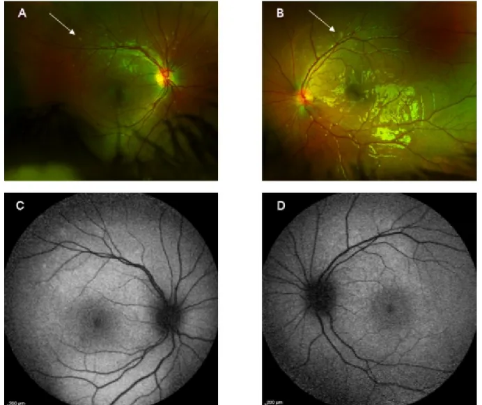 Figure 3: Fundoscopic images three weeks after initial presentation show multiple yellow deposits scattered around the vascular arcades (A and B, see arrows), with corresponding mild hyperautofluorescence (C, D).