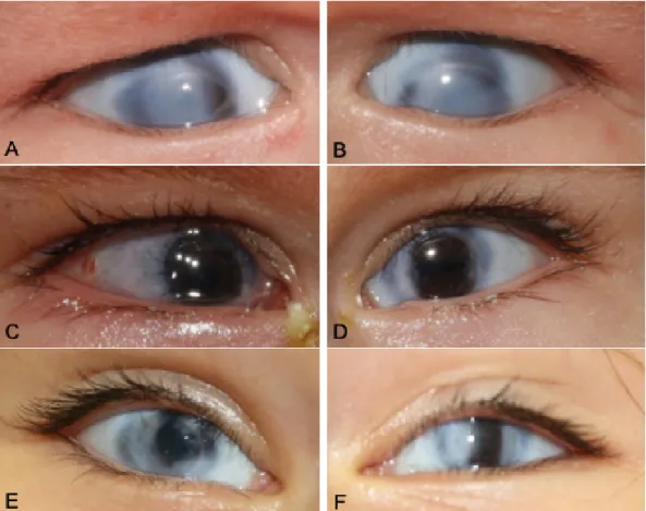 Figure 1: Pre- and postoperative stages of penetrating keratoplasty (PK) of the presenting case