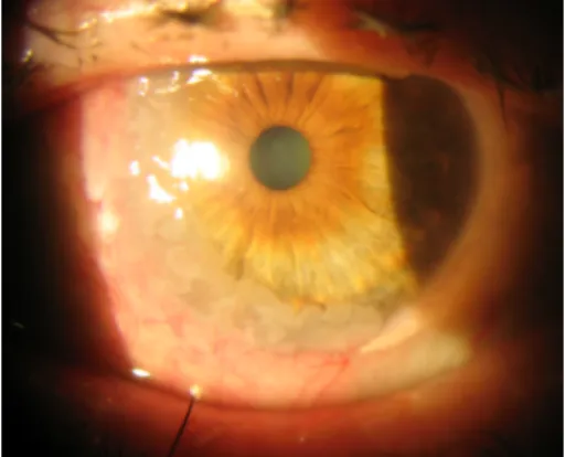 Figure 1: Slit-lamp examination; nasal limbal gelatinous mass with inferior corneal infiltration