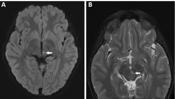 Figure 2: MRI scan of the brain showing tiny infarct (white arrow) in the left paramedian rostral upper midbrain at the level of the red nucleus; (A) axial diffusion weighted image showing restricted diffusion in the T2 hyperintensity, and (B) axial T2 fat