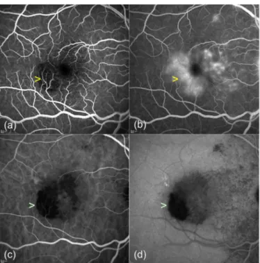 Figure 1: Fluorescein angiography (FA) and indocyanine green angiography (ICGA) of acute syphilitic posterior placoid chorioretinitis in the right eye at presentation