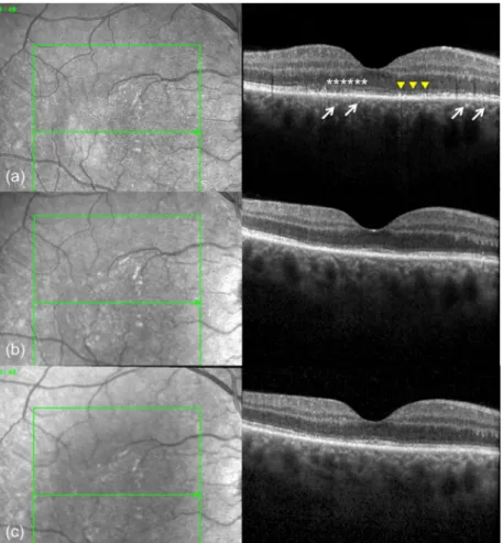 Figure 3: (a) Spectral domain optical coherence tomography (SD-OCT) scan of the right eye at presentation shows disruption of the ellipsoid zone (white asterisks), nodular thickening of the retinal pigment epithelium (yellow arowheads) and punctate hyperre