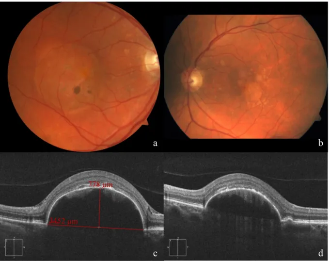 Figure 1: Fundus appearance and morphological evaluation of both eyes 4 weeks before operation of the right eye.