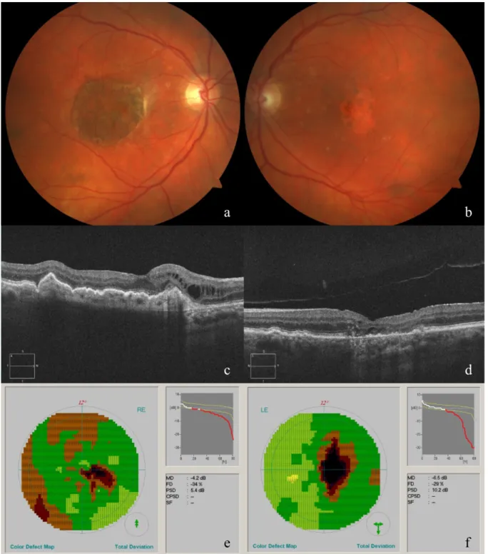 Figure 2: Fundus appearance and morphological and functional evaluation of both eyes at the last consultation.