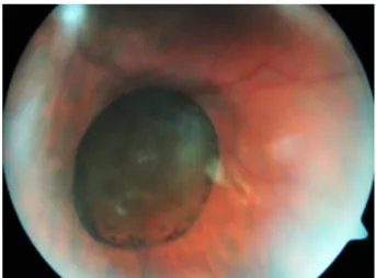 Figure 1: Fundus photograph showing the free-floating, pigmented vitreous cyst